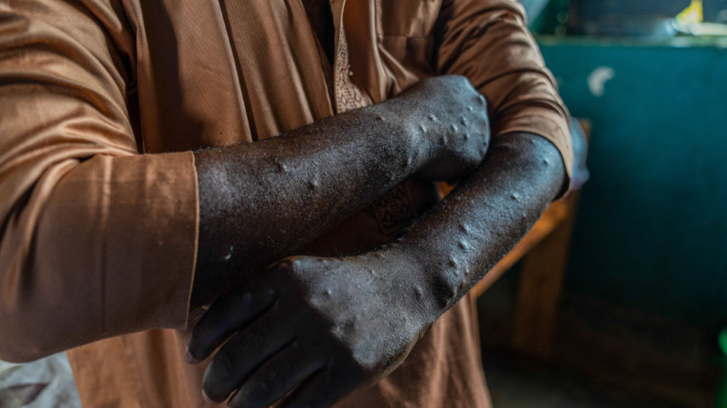 Un paciente infectado con viruela del mono muestra lesiones en su cuerpo en el centro de tratamiento de Kamituga, provincia de Kivu del Sur, en el este de la República Democrática del Congo, el 20 de septiembre de 2024. (Glody Murhabazi/AFP a través de Getty Images)